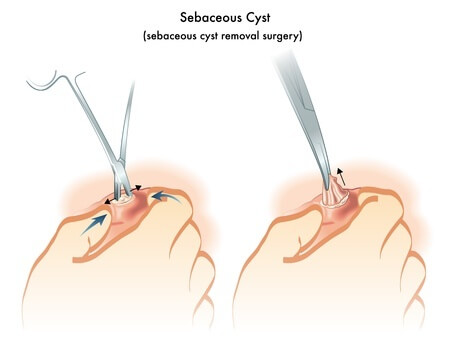 Facial cyst wikipedia