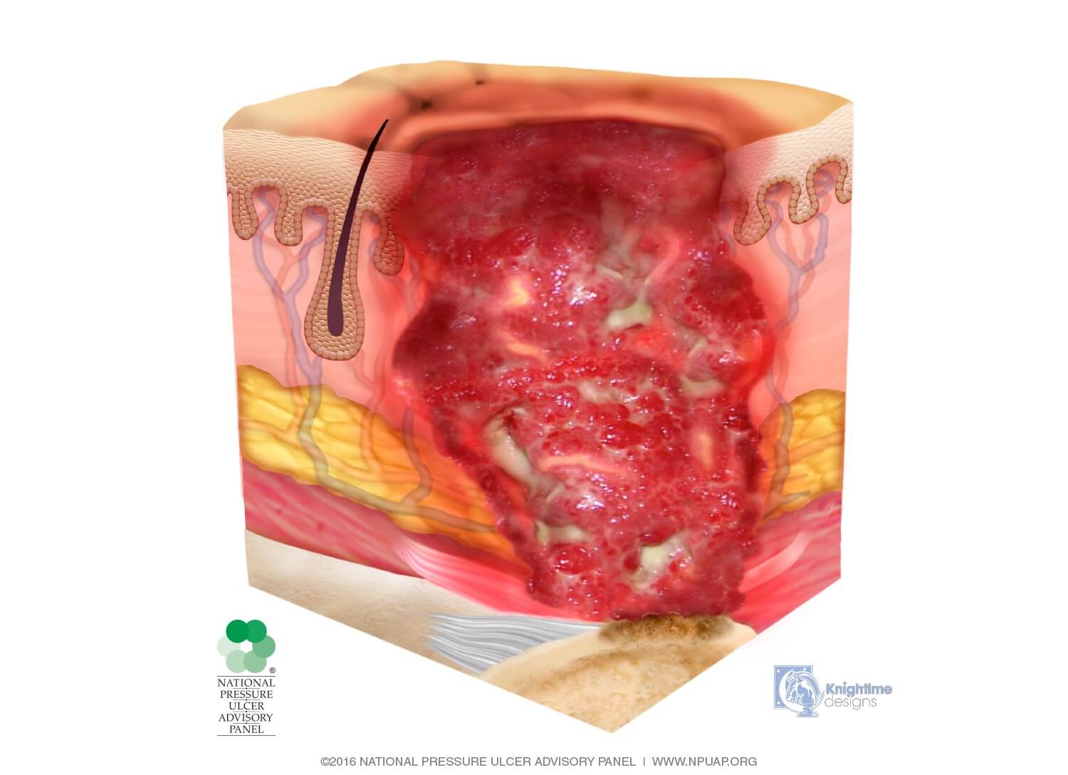 Pressure Ulcer Staging System - Dr. Novikov Wellness and Skin Care